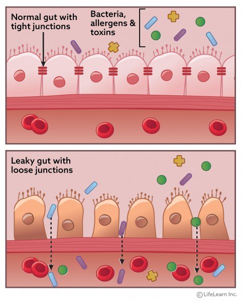 The Leaky Gut and Eczema Connection