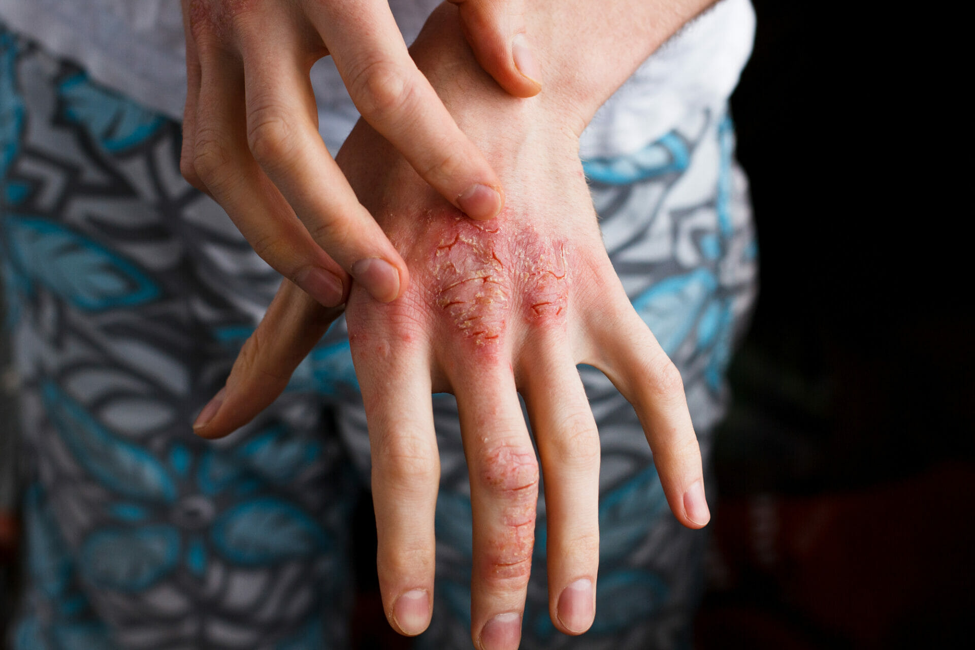 Natural Ways To Deal With Eczema On Hands Dr Ana Maria Temple